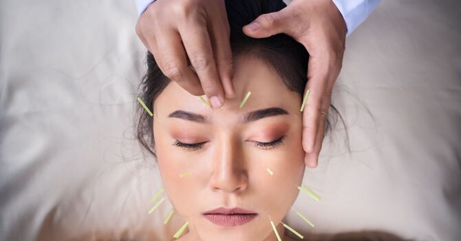 Acupuncture